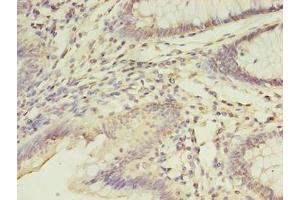 Immunohistochemistry of paraffin-embedded human colon cancer using ABIN7152867 at dilution of 1:100 (FGL2 抗体  (AA 24-439))