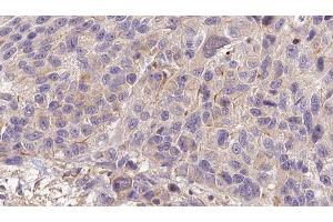 ABIN6273207 at 1/100 staining Human melanoma tissue by IHC-P. (CFHR3 抗体)