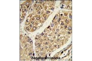 Formalin-fixed and paraffin-embedded human hepatocarcinoma reacted with CSGALNACT2 Antibody (Center), which was peroxidase-conjugated to the secondary antibody, followed by DAB staining. (CSGALNACT2 抗体  (AA 200-229))