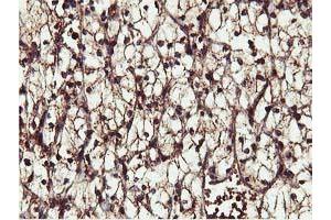 Immunohistochemical staining of paraffin-embedded Carcinoma of Human kidney tissue using anti-IDS mouse monoclonal antibody. (IDS 抗体)