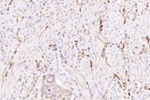 Immunohistochemistry analysis of paraffin-embedded human cervical cancer using NXF2 (ABIN7074901) at dilution of 1: 3000 (NXF2 抗体)