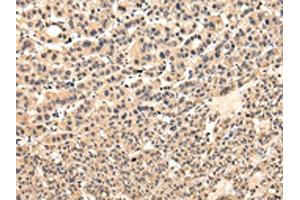 The image on the left is immunohistochemistry of paraffin-embedded Human liver cancer tissue using ABIN7131585(VPS37D Antibody) at dilution 1/30, on the right is treated with fusion protein. (VPS37D 抗体)