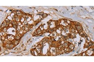 Immunohistochemistry of paraffin-embedded Human breast cancer tissue using MTUS1 Polyclonal Antibody at dilution 1:40 (MTUS1 抗体)