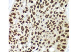 Immunohistochemistry of paraffin-embedded Human lung cancer using SF3B2 Polyclonal Antibody at dilution of 1:100 (40x lens). (SF3B2 抗体)