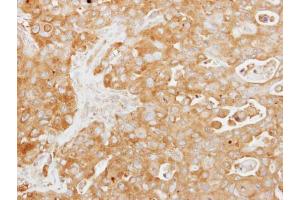 IHC-P Image Immunohistochemical analysis of paraffin-embedded human colon carcinoma, using Tuftelin 1, antibody at 1:250 dilution. (TUFT1 抗体)