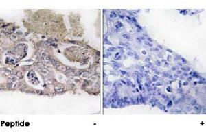 Immunohistochemical analysis of paraffin-embedded human colon carcinoma tissue using MARK2 polyclonal antibody . (MARK2 抗体)