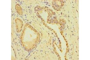 Immunohistochemistry of paraffin-embedded human prostate cancer using ABIN7148722 at dilution of 1:100 (CSMD2 抗体  (AA 1-225))