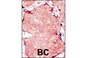 Formalin-fixed and paraffin-embedded human cancer tissue reacted with the primary antibody, which was peroxidase-conjugated to the secondary antibody, followed by AEC staining. (Adenylate Kinase 3 抗体  (C-Term))