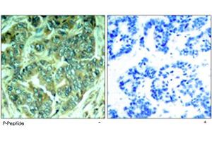 Immunohistochemical analysis of paraffin-embedded human breast carcinoma tissue using DOK1 (phospho Y398) polyclonal antibody . (DOK1 抗体  (pTyr398))