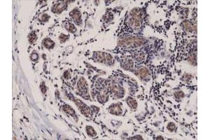 Immunohistochemical staining (Formalin-fixed paraffin-embedded sections) of human breast cancer with DIABLO monoclonal antibody, clone RM271 .