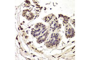 Immunohistochemistry of paraffin-embedded Human mammary cancer using INTS6 antibody at dilution of 1:100 (x400 lens). (INTS6 抗体)