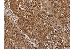 The image on the left is immunohistochemistry of paraffin-embedded Human lung cancer tissue using ABIN7192693(STMN2/STMN3/STMN4 Antibody) at dilution 1/45, on the right is treated with synthetic peptide. (STMN2/STMN3/STMN4 抗体)
