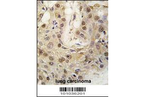 Formalin-fixed and paraffin-embedded human lung carcinoma tissue reacted with cGKII antibody , which was peroxidase-conjugated to the secondary antibody, followed by DAB staining. (PRKG2 抗体  (C-Term))