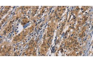 Immunohistochemistry of paraffin-embedded Human gastric cancer tissue using PIKFYVE Polyclonal Antibody at dilution 1:50 (PIKFYVE 抗体)