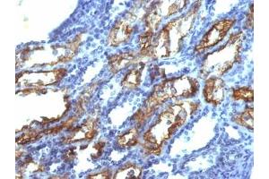 IHC testing of FFPE human renal cell carcinoma with IFN gamma antibody (clone IFNG/466). (Interferon gamma 抗体)