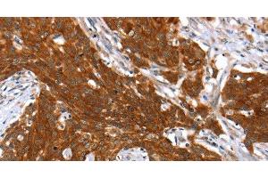 Immunohistochemistry of paraffin-embedded Human cervical cancer tissue using HOXB1 Polyclonal Antibody at dilution 1:40 (HOXB1 抗体)