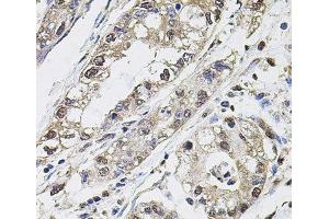 Immunohistochemistry of paraffin-embedded Human gastric cancer using CA9 Polyclonal Antibody at dilution of 1:100 (40x lens). (CA9 抗体)