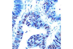 Immunohistochemistry of paraffin-embedded human colon carcinoma using USP7/HAUSP Rabbit mAb (ABIN7271168) at dilution of 1:100 (40x lens). (USP7 抗体)