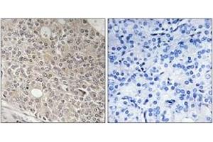 Immunohistochemistry analysis of paraffin-embedded human prostate carcinoma tissue, using AMOTL1 Antibody. (AMOTL1 抗体  (AA 441-490))