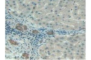 Detection of C1INH in Human Liver Cancer Tissue using Polyclonal Antibody to Complement 1 Inhibitor (C1INH)