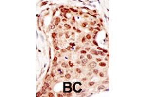 Formalin-fixed and paraffin-embedded human cancer tissue reacted with the primary antibody, which was peroxidase-conjugated to the secondary antibody, followed by DAB staining. (CBLC 抗体  (C-Term))