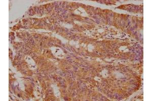 Immunohistochemical of paraffin-embedded human colon cancer using ABIN7173328 at dilution of 1:50 (TFF3 抗体)