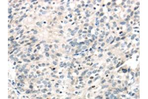 The image on the left is immunohistochemistry of paraffin-embedded Human ovarian cancer tissue using ABIN7191116(IQGAP2 Antibody) at dilution 1/40, on the right is treated with synthetic peptide. (IQGAP2 抗体)