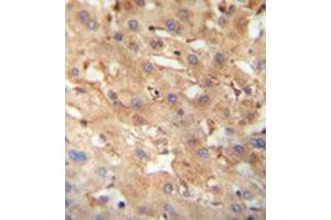 Immunohistochemistry analysis in formalin fixed and paraffin embedded human hepatocarcinoma reacted with NEU4 Antibody (C-term) followed which was peroxidase conjugated to the secondary antibody and followed by DAB staining.
