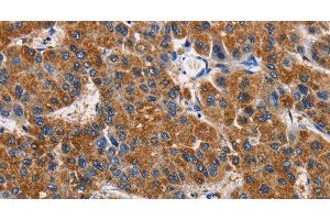 Immunohistochemistry of paraffin-embedded Human liver cancer tissue using APLNR Polyclonal Antibody at dilution 1:50 (Apelin Receptor 抗体)