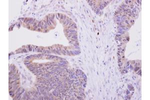 IHC-P Image H6PD antibody [N2N3] detects H6PD protein at cytoplasm on human colon carcinoma by immunohistochemical analysis. (Glucose-6-Phosphate Dehydrogenase 抗体)