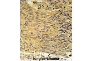 LCLT1 Antibody (C-term) (ABIN651910 and ABIN2840449) immunohistochemistry analysis in formalin fixed and paraffin embedded human lung carcinoma followed by peroxidase conjugation of the secondary antibody and DAB staining. (LCLAT1 抗体  (AA 296-324))