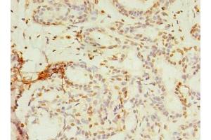 Immunohistochemistry of paraffin-embedded human breast cancer using ABIN7142992 at dilution of 1:100 (SMPDL3A 抗体  (AA 51-350))