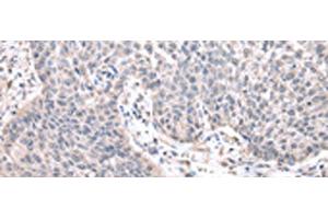 Immunohistochemistry of paraffin-embedded Human lung cancer tissue using ZNF239 Polyclonal Antibody at dilution of 1:25(x200) (ZNF239 抗体)