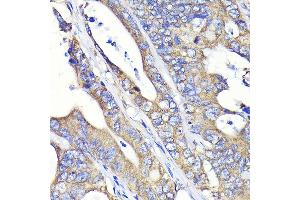 Immunohistochemistry of paraffin-embedded human colon carcinoma using Fatty Acid Synthase (FASN) Rabbit mAb  at dilution of 1:100 (40x lens). (Fatty Acid Synthase 抗体)