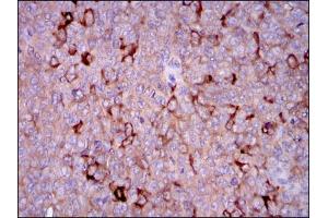 Immunohistochemical analysis of paraffin-embedded ovarian cancer tissues using G6PD mouse mAb with DAB staining.