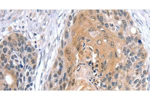 Immunohistochemistry of paraffin-embedded Human esophagus cancer using GNAT3 Polyclonal Antibody at dilution of 1:35 (GNAT3 抗体)