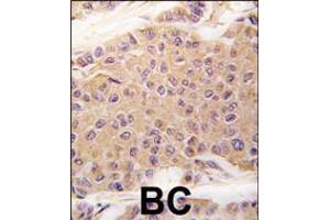 Formalin-fixed and paraffin-embedded human breast carcinoma tissue reacted with TGFB2 antibody , which was peroxidase-conjugated to the secondary antibody, followed by DAB staining. (TGFB2 抗体  (C-Term))
