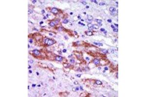 Formalin-fixed and paraffin-embedded human cancer tissue reacted with the primary antibody, which was peroxidase-conjugated to the secondary antibody, followed by DAB staining. (Casein Kinase 1 delta 抗体  (C-Term))