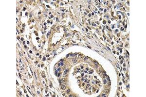 Immunohistochemistry of paraffin-embedded Human gastric cancer using ARRB2 Polyclonal Antibody at dilution of 1:200 (40x lens).