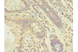 Immunohistochemistry of paraffin-embedded human colon cancer using ABIN7143952 at dilution of 1:100 (ABHD14A 抗体  (AA 56-258))