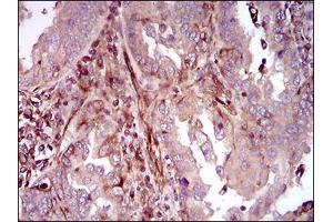 Immunohistochemical analysis of paraffin-embedded endometrial cancer tissues using MAPK14 mouse mAb with DAB staining. (MAPK14 抗体  (AA 299-360))
