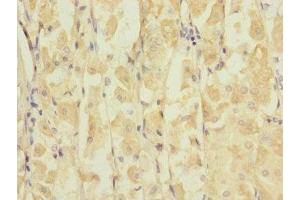Immunohistochemistry of paraffin-embedded human gastric cancer using ABIN7153977 at dilution of 1:100 (GRIK3 抗体  (AA 32-240))