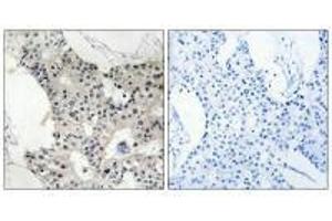 Immunohistochemistry analysis of paraffin-embedded human breast carcinoma tissue using BAGE4 antibody.