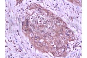 Formalin-fixed and paraffin embedded human cervical tissue labeled with Anti-STAT3 Polyclonal Antibody (ABIN738261), Unconjugated at 1:200 followed by conjugation to the secondary antibody, (SP-0023), and DAB staining (STAT3 抗体  (AA 233-330))