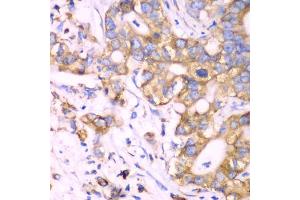Immunohistochemistry of paraffin-embedded human liver cancer using RPS3A Antibody (ABIN5973489) at dilution of 1/100 (40x lens). (RPS3A 抗体)