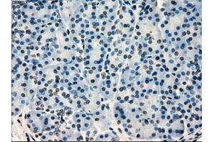 Immunohistochemical staining of paraffin-embedded Adenocarcinoma of colon tissue using anti-SATB1mouse monoclonal antibody. (SATB1 抗体)