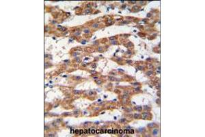 Formalin-fixed and paraffin-embedded human hepatocarcinoma tissue reacted with PHB antibody , which was peroxidase-conjugated to the secondary antibody, followed by DAB staining. (Prohibitin 抗体  (AA 89-117))