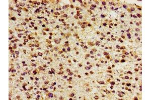 Immunohistochemistry of paraffin-embedded human glioma using ABIN7153030 at dilution of 1:100 (FOXD3 抗体  (AA 1-140))