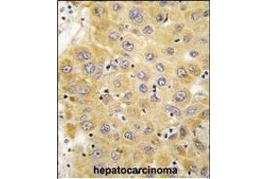 Formalin-fixed and paraffin-embedded human hepatocarcinoma tissue reacted with CTGF antibody (C-term) (ABIN392204 and ABIN2841904) , which was peroxidase-conjugated to the secondary antibody, followed by DAB staining. (CTGF 抗体  (C-Term))