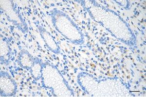 Immunohistochemistry was performed on paraffin-embedded human gastric carcinoma using LMAN1 antibody (ABIN7799245), 1:200). (Recombinant LMAN1 抗体)